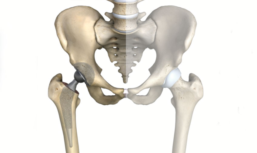 Hip Replacement Surgery in Jaipur