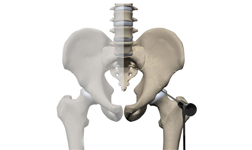 Hip Arthroscopy Surgery