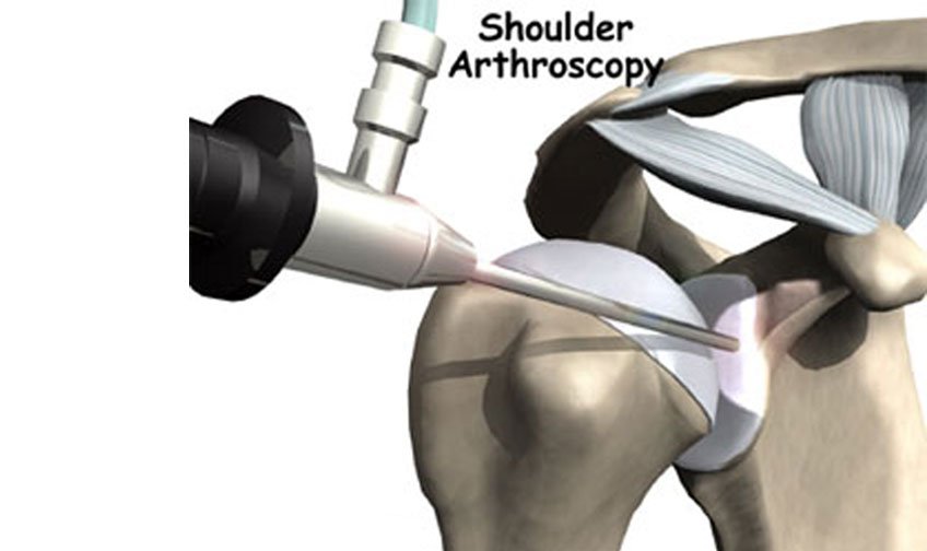 Shoulder Arthroscopy in Jaipur