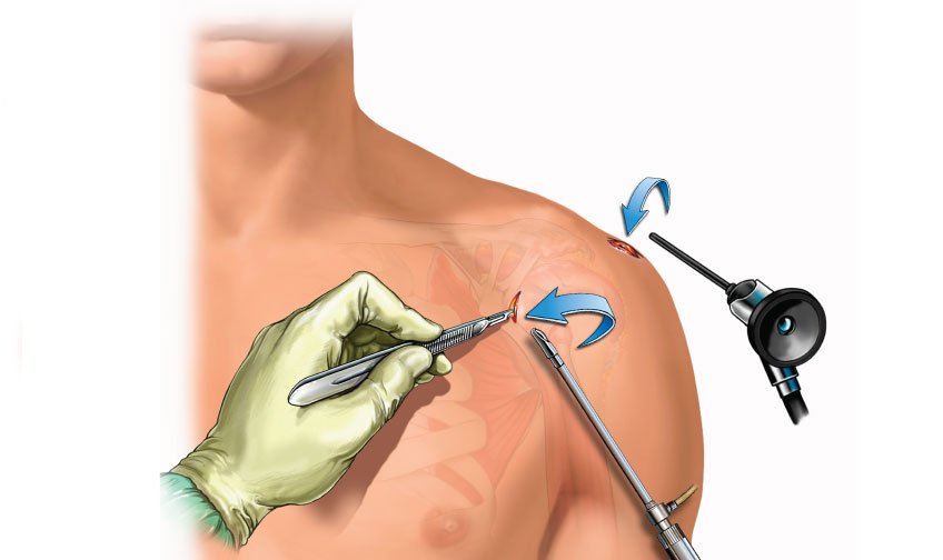 Shoulder Arthroscopy Surgery in Jaipur