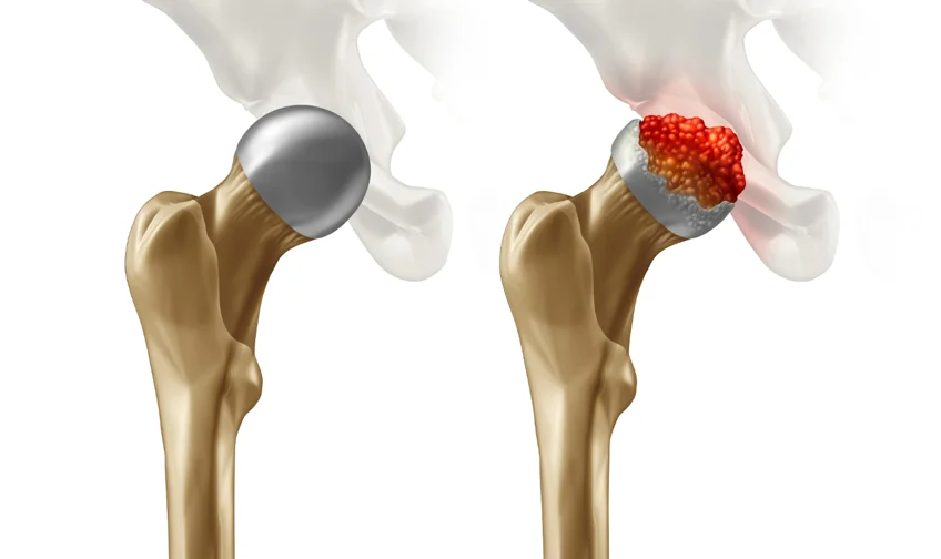 Hip AVN Treatment