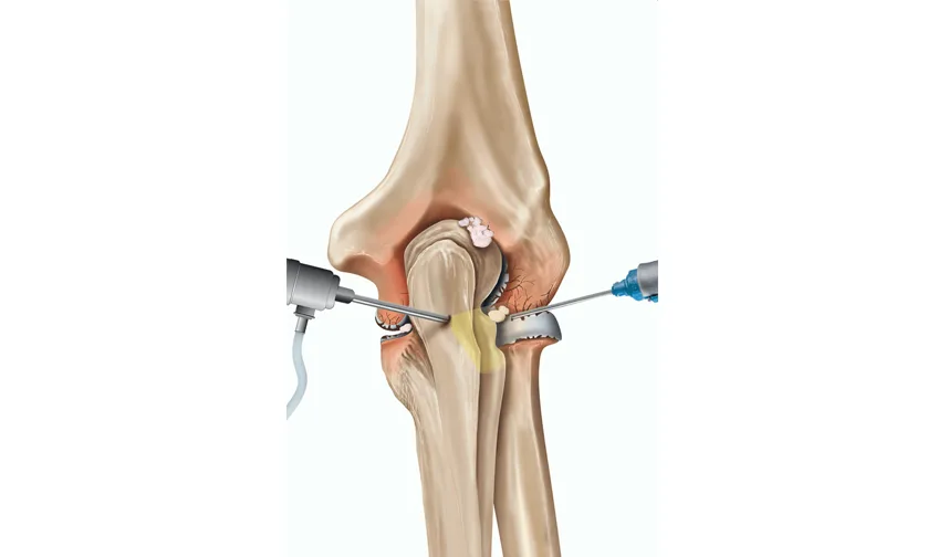 arthroscopy