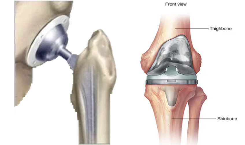 Knee Replacement