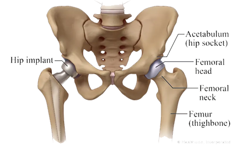 Partial Hip Replacement Surgery