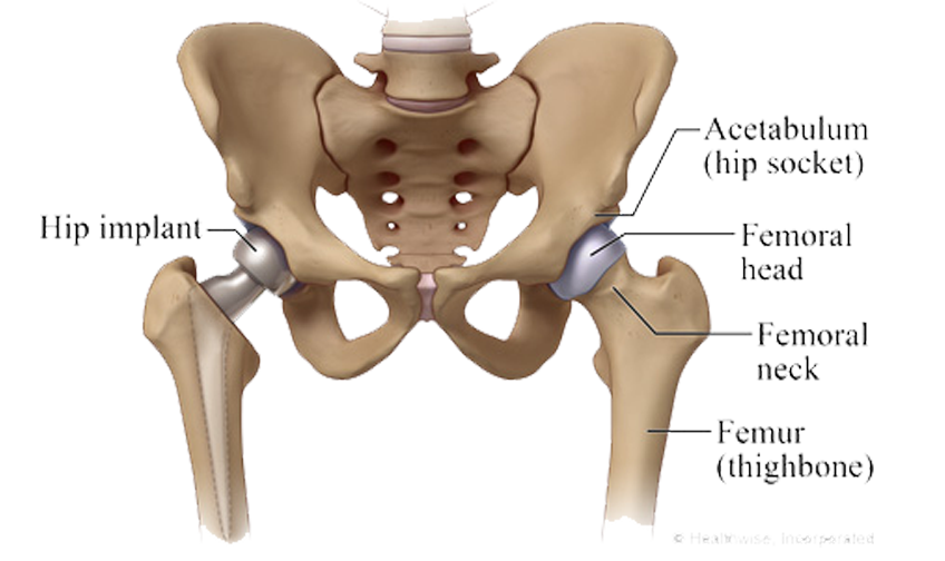 Partial Hip Replacement Surgery