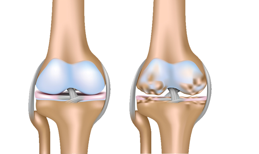 Knee Arthritis