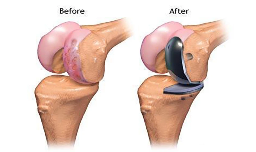 Partial Knee Replacement Surgery