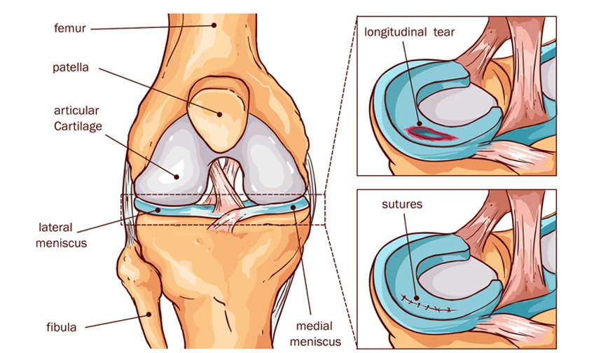 Meniscus Tear