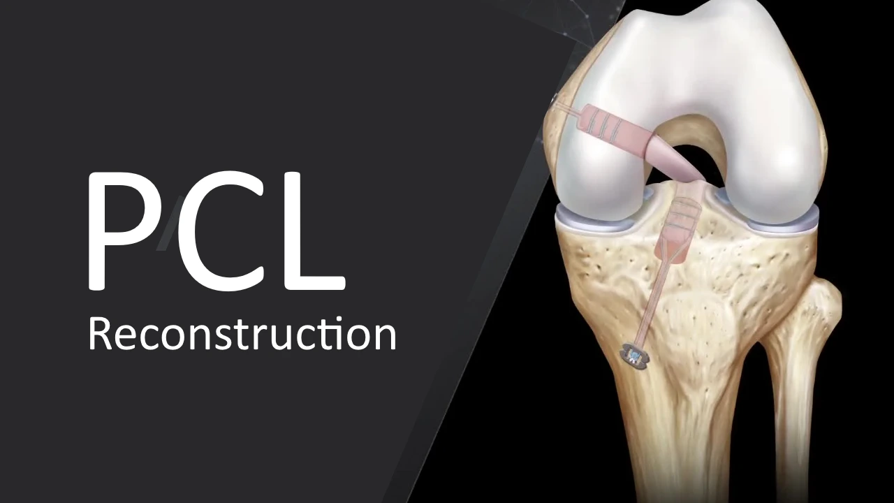 PCL Reconstruction