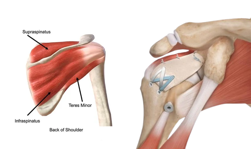 Rotator Cuff Tear