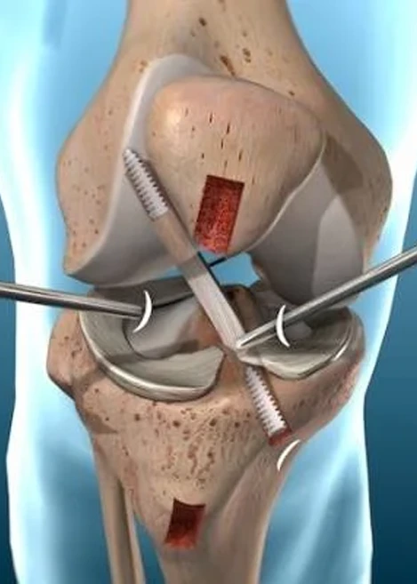 Knee Arthroscopy