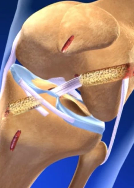 ACL Reconstruction