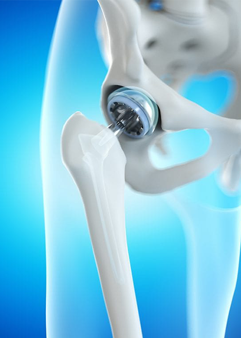 Hip Replacement