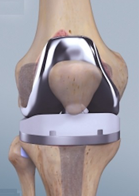 Knee Replacement