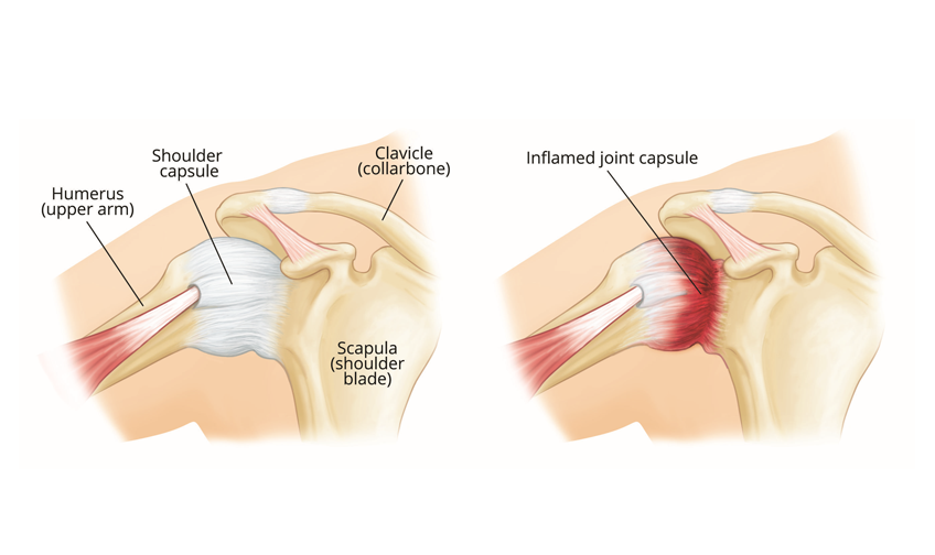 Frozen Shoulder Treatment