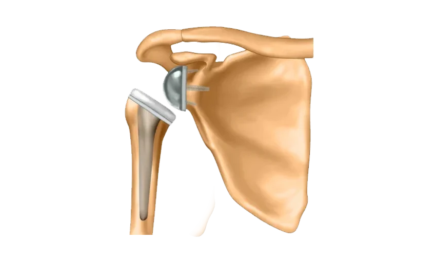 Reverse Shoulder Replacement