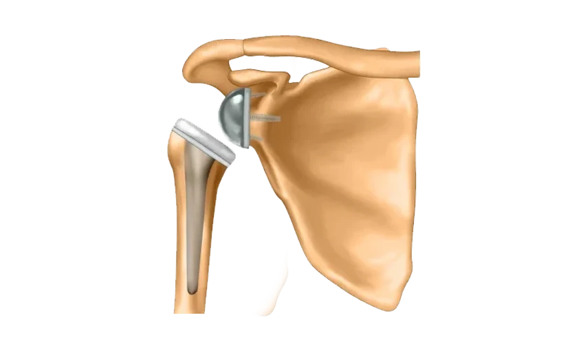 Reverse Shoulder Replacement