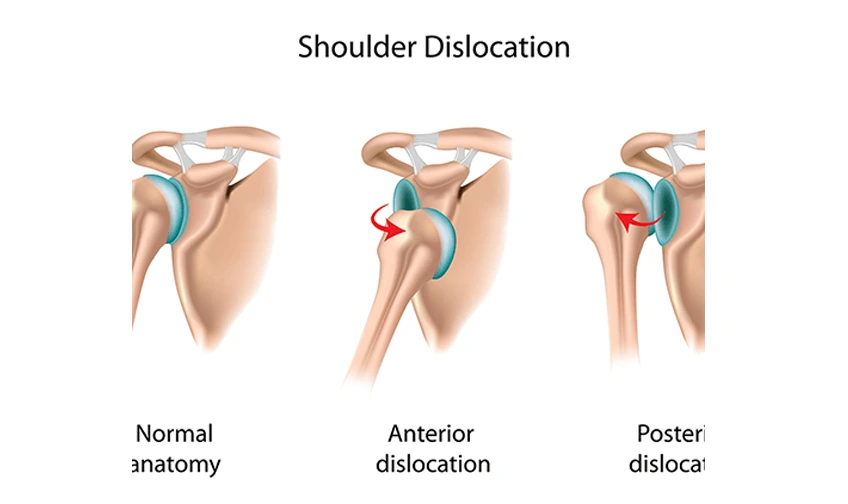 Shoulder Dislocation